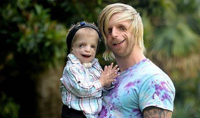 Man With Rare Condition Flies All The Way To Australia To Meet A 2-Year-Old With The Same Disorder