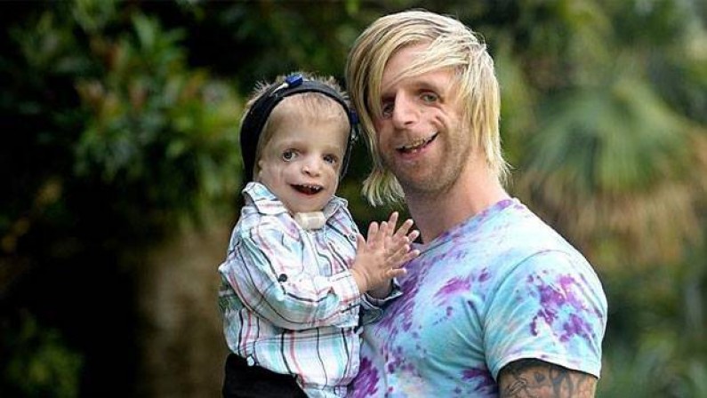 Man With Rare Condition Flies All The Way To Australia To Meet A 2-Year-Old With The Same Disorder